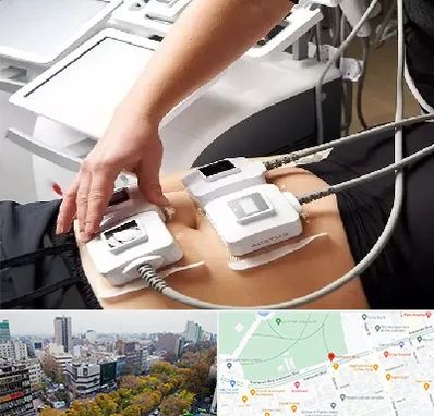 ترواسکالپ در بلوار کشاورز 