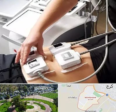 ترواسکالپ در مهرشهر کرج 