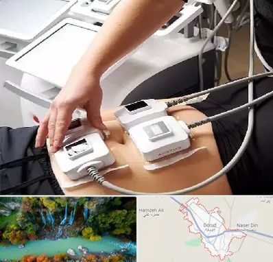 ترواسکالپ در دورود