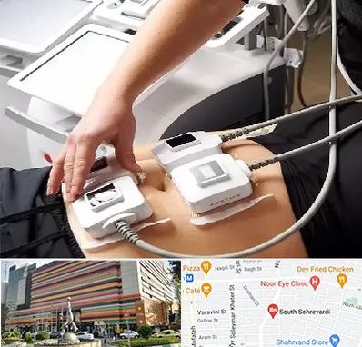 ترواسکالپ در سهروردی 