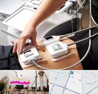 ترواسکالپ در پادادشهر اهواز