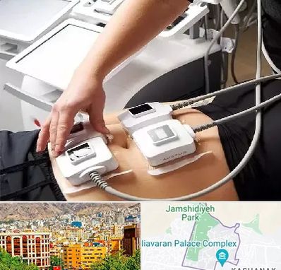 ترواسکالپ در نیاوران 