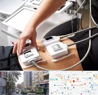 ترواسکالپ در فاطمی 