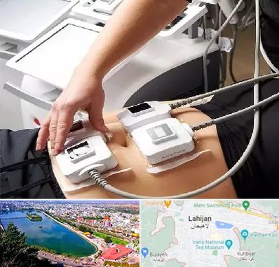 ترواسکالپ در لاهیجان