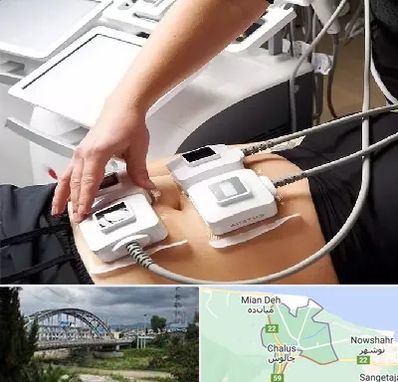 ترواسکالپ در چالوس