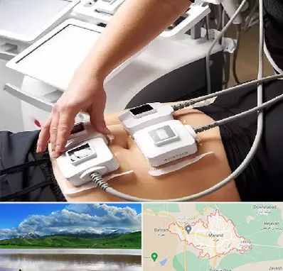 ترواسکالپ در مرند