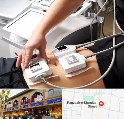 ترواسکالپ در 15 خرداد