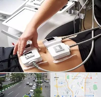 ترواسکالپ در ستارخان 