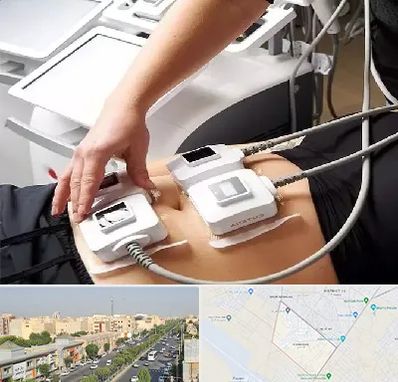 ترواسکالپ در کیانمهر کرج