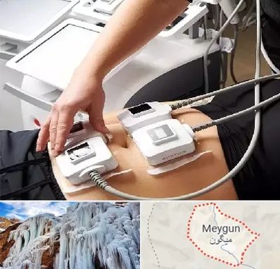 ترواسکالپ در میگون