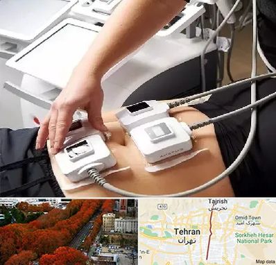 ترواسکالپ در ولیعصر 