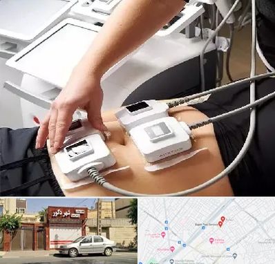 ترواسکالپ در باجک قم