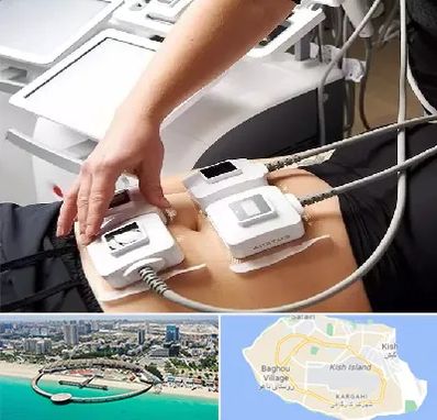 ترواسکالپ در کیش