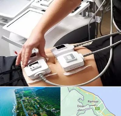 ترواسکالپ در رامسر