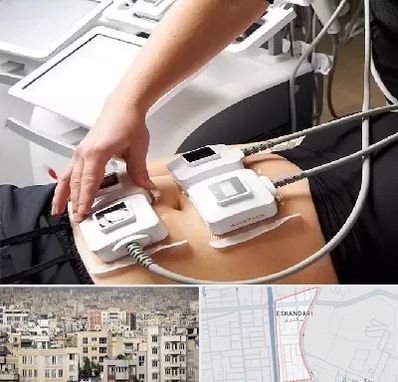 ترواسکالپ در اسکندری