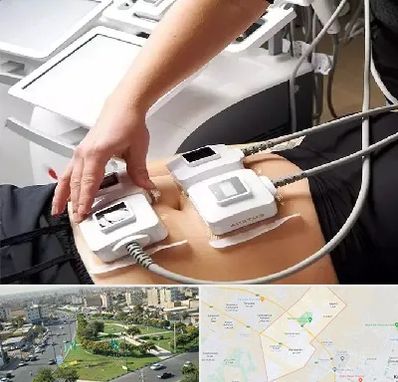 ترواسکالپ در کمال شهر کرج 