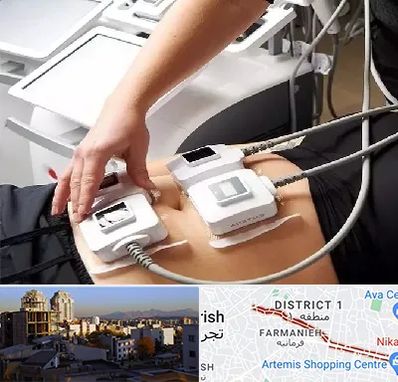 ترواسکالپ در فرمانیه 