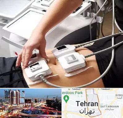 ترواسکالپ در صادقیه 