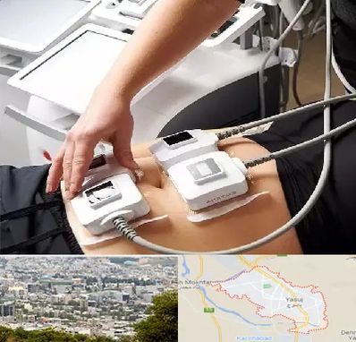 ترواسکالپ در یاسوج