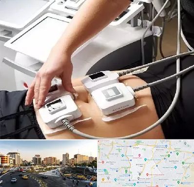 ترواسکالپ در منطقه 7 تهران 