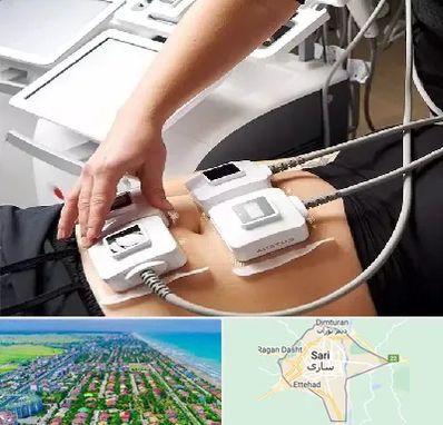 ترواسکالپ در ساری