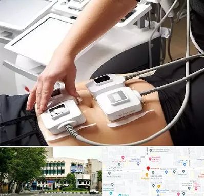 ترواسکالپ در طالقانی 