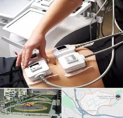 ترواسکالپ در مرزداران تبریز