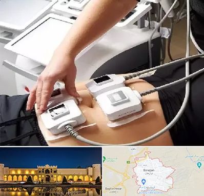 ترواسکالپ در برازجان