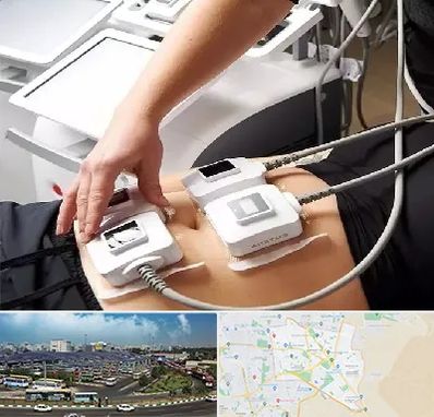 ترواسکالپ در منطقه 15 تهران 