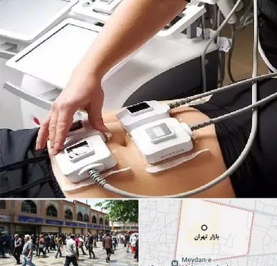 ترواسکالپ در بازار تهران