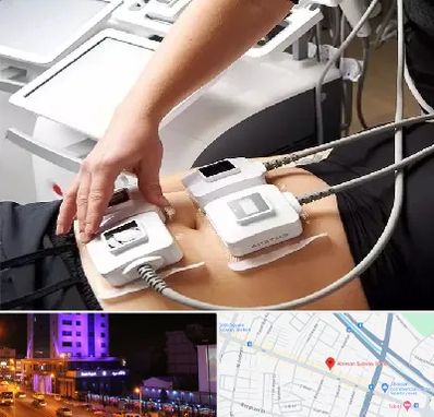 ترواسکالپ در آبرسان تبریز