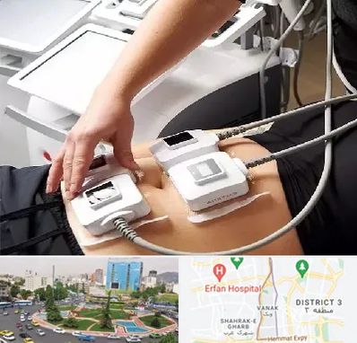 ترواسکالپ در ونک 