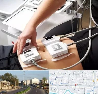 ترواسکالپ در ضیابری رشت