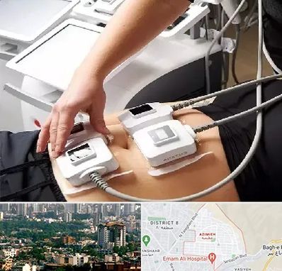 ترواسکالپ در عظیمیه کرج 