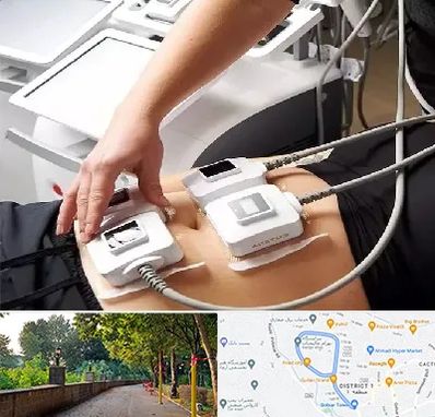 ترواسکالپ در بلوار گیلان رشت