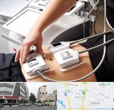 ترواسکالپ در بلوار فردوس 