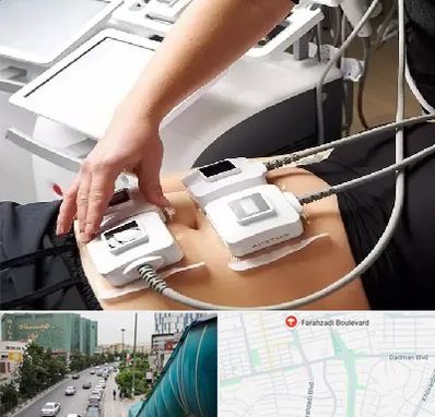ترواسکالپ در بلوار فرحزادی