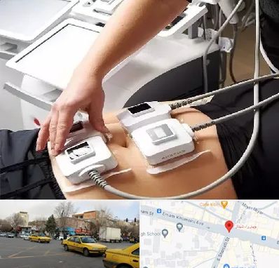 ترواسکالپ در شهناز تبریز