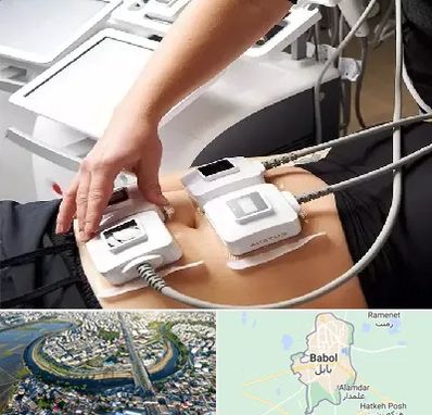 ترواسکالپ در بابل