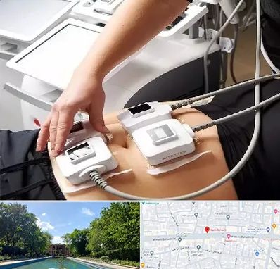 ترواسکالپ در هشت بهشت اصفهان