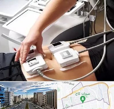 ترواسکالپ در سعادت آباد 