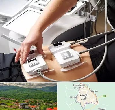 ترواسکالپ در آمل