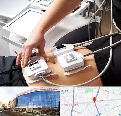 ترواسکالپ در نصف راه تبریز