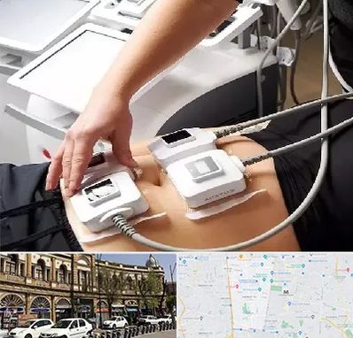 ترواسکالپ در منطقه 11 تهران 