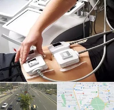 ترواسکالپ در منطقه 17 تهران 