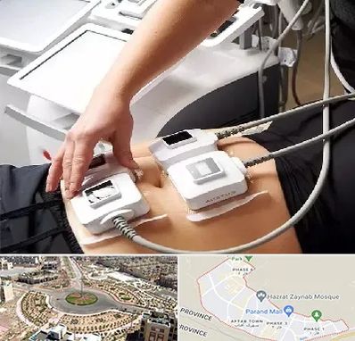 ترواسکالپ در پرند