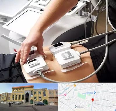 ترواسکالپ در زنبیل آباد قم