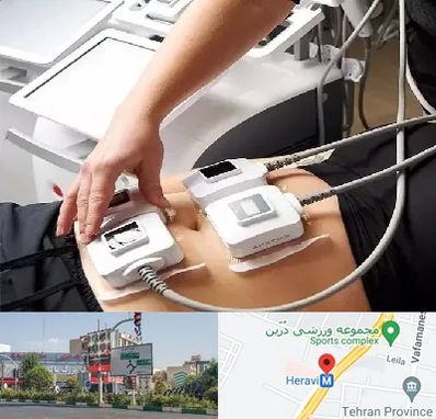 ترواسکالپ در هروی 