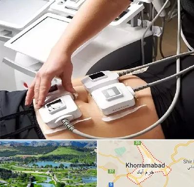 ترواسکالپ در خرم آباد