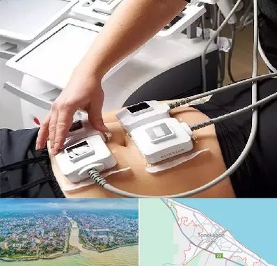 ترواسکالپ در تنکابن